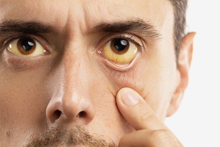 Man checking his health condition. Yellowish eyes is sign of problems with liver, viral infection or other disease_